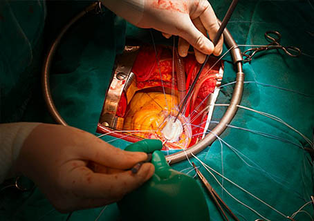 جراحی قلب و عروق